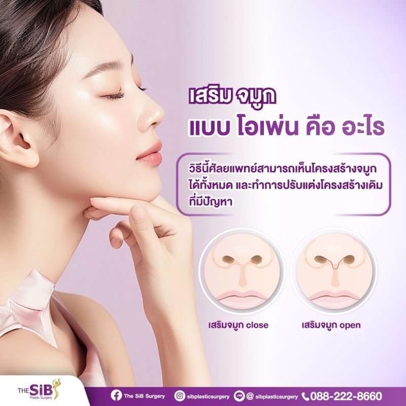 เสริมจมูกโอเพ่นคืออะไร