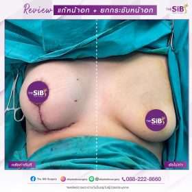 ยกกระชับหน้าอก