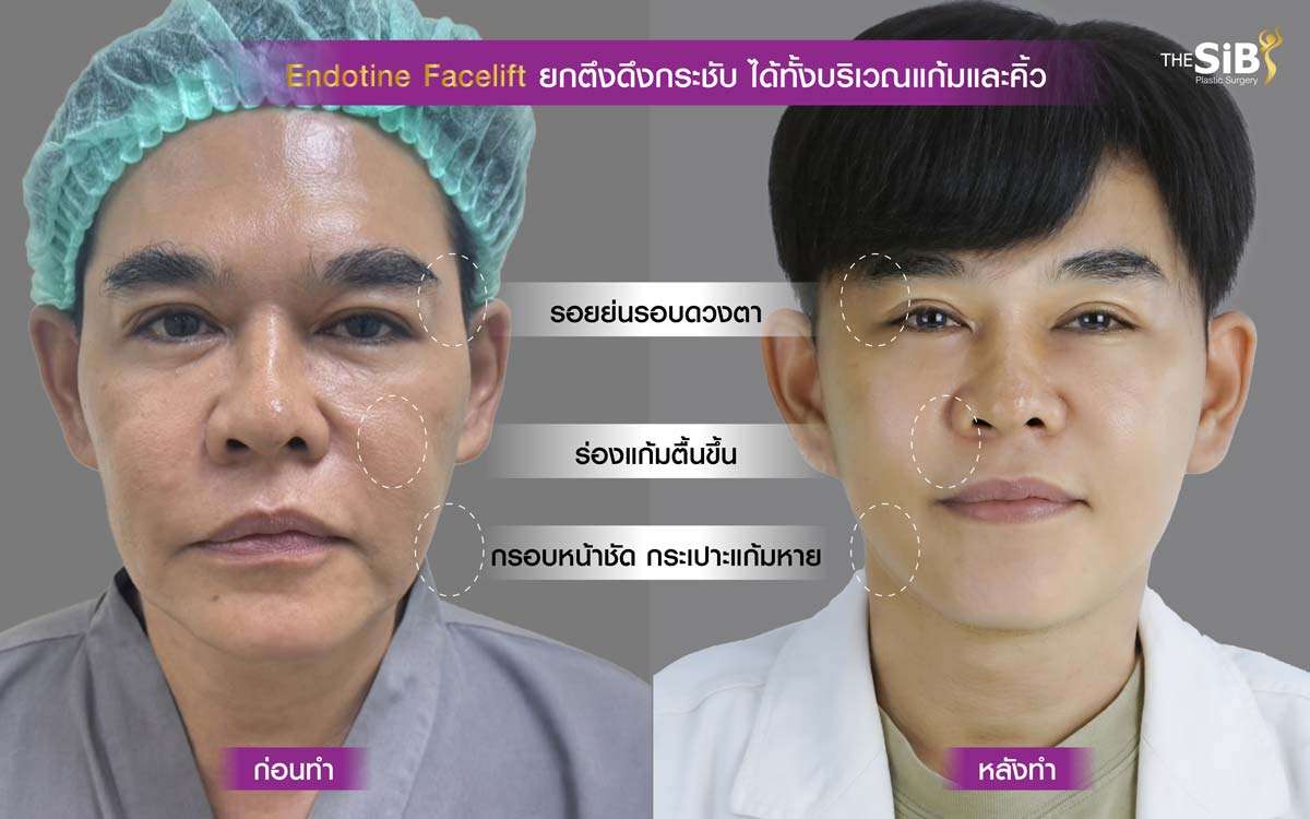 ดึงหน้า , Endotine , Deep SMAS