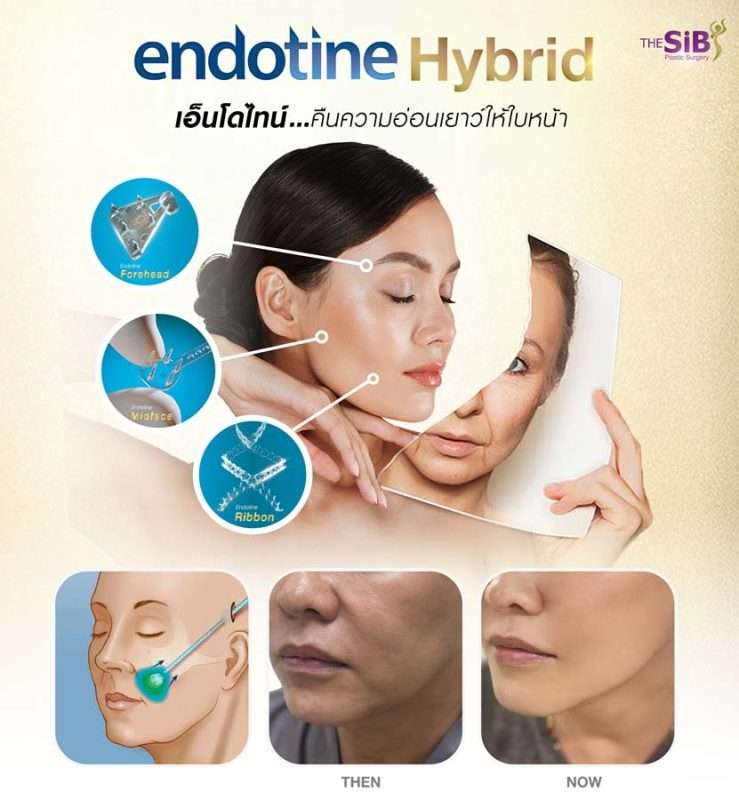 endotine