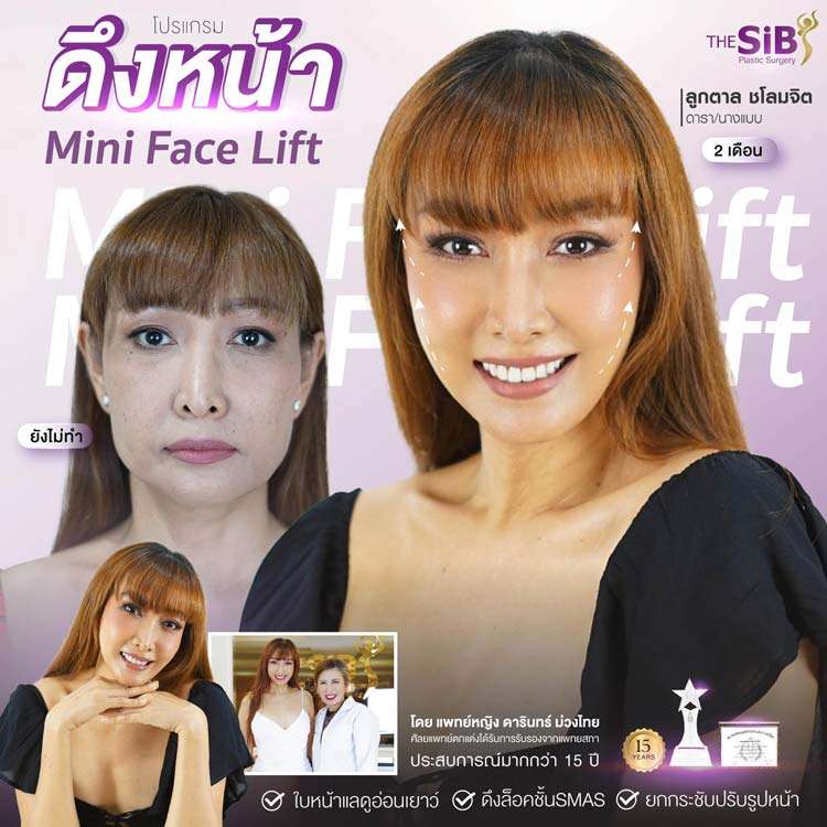 ดึงหน้า อายุเท่าไหร่, ลูกตาล , mini facelift