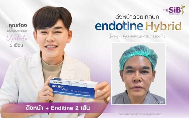 รีวิว Endotine , รีวิวดึงหน้า