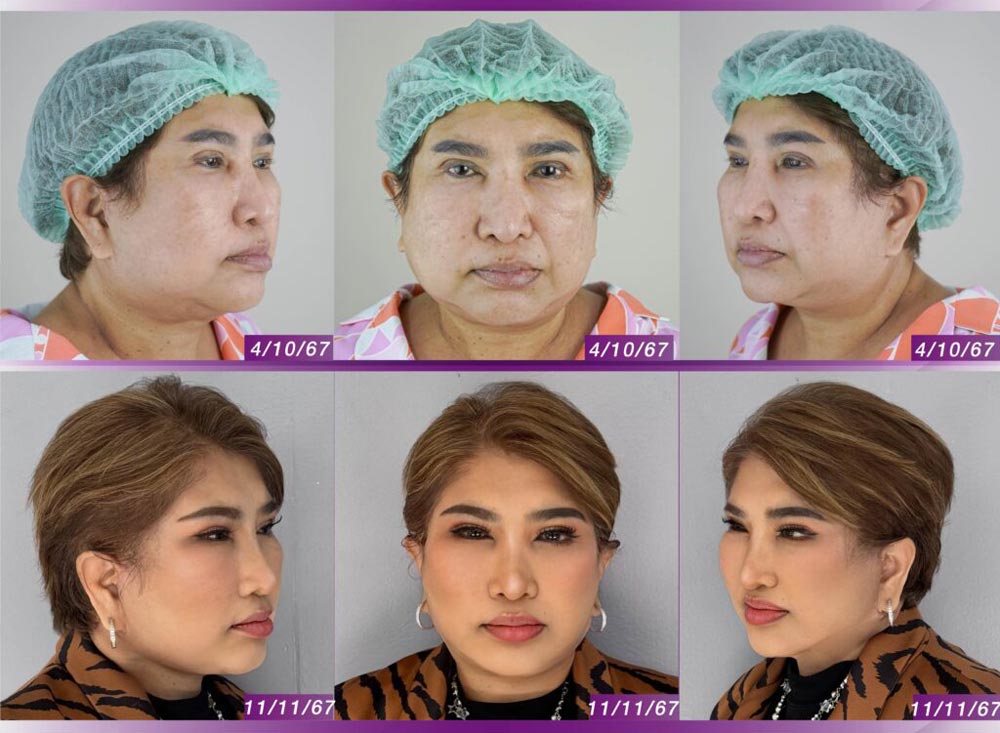 ดึงหน้า , แม่ต้อย