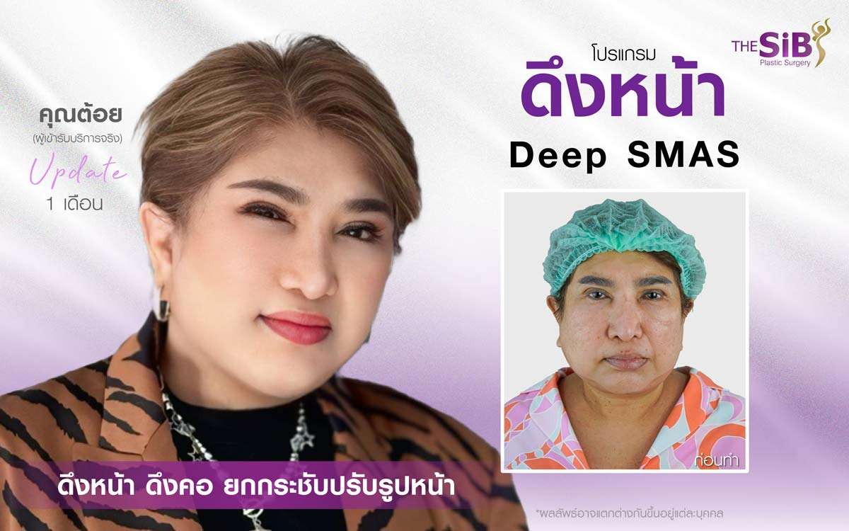 รีวิวดึงหน้า ดึงคอ