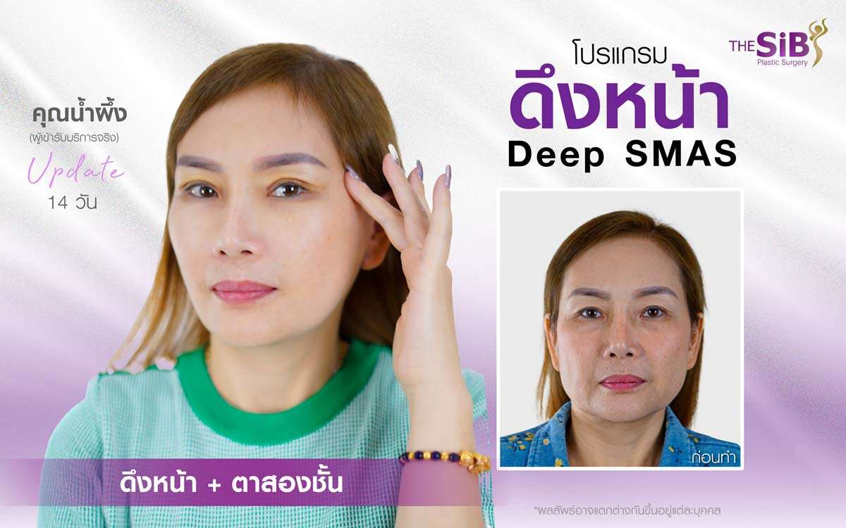 รีวิวดึงหน้า , ตาสองชั้น