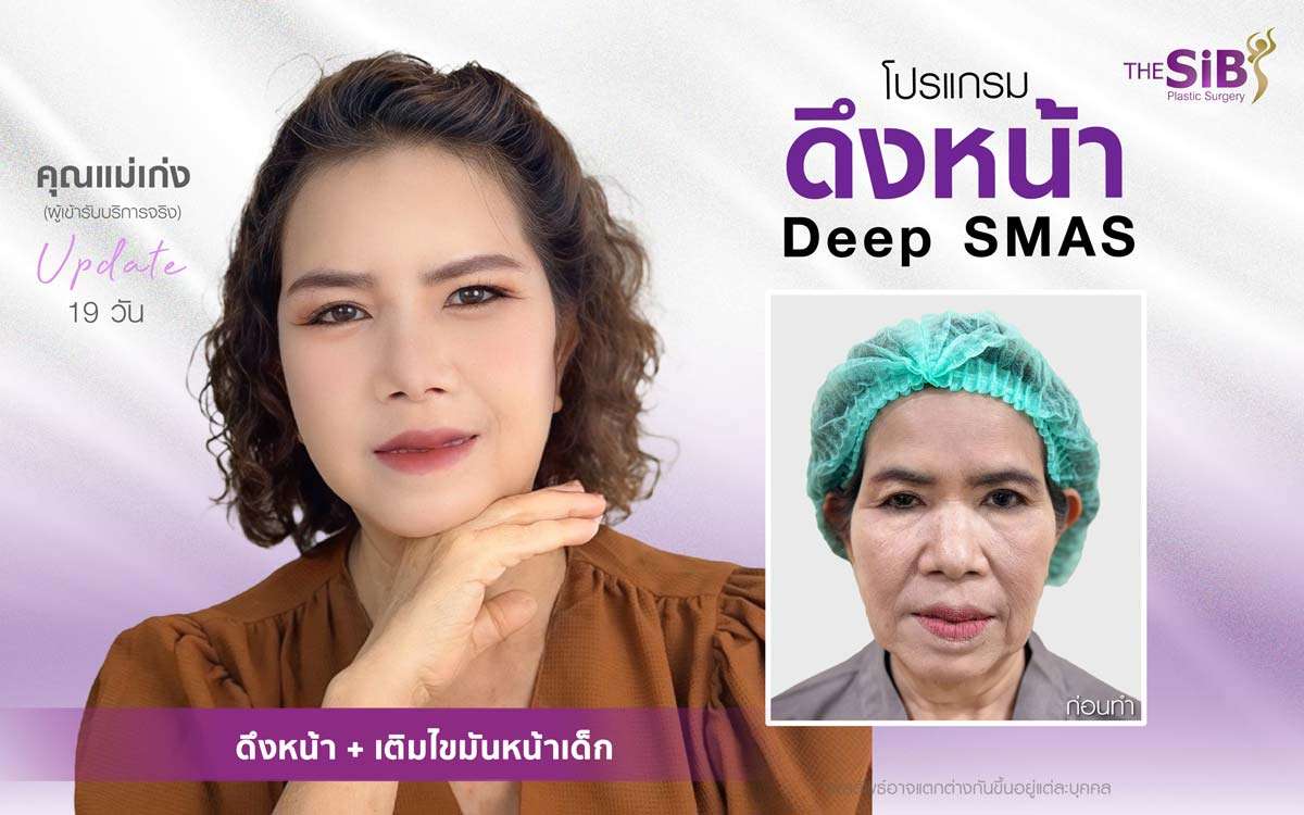 รีวิวดึงหน้า , เติมไขมันหน้าเด็ก