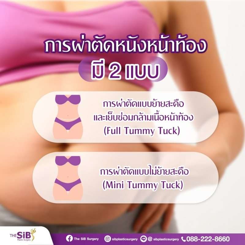 ผ่าตัดหนังหน้าท้อง การตัดหนังหน้าท้องมีกี่แบบ ศัลยกรรมตัดหนังหน้าท้อง