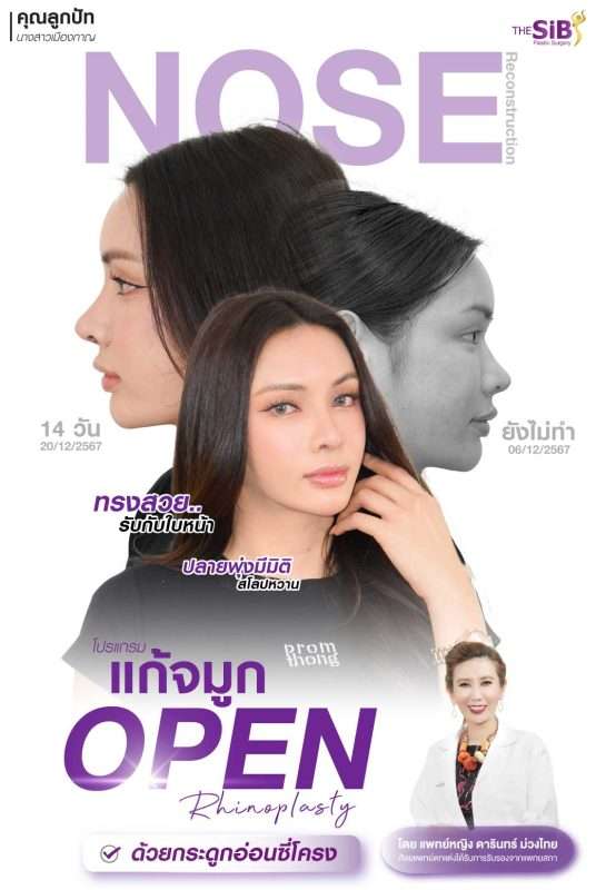 ปรับหน้าแข็งให้ดูหวานมากขึ้น แก้จมูกแบบโอเพ่นด้วยกระดูกอ่อนซี่โครงตัวเอง