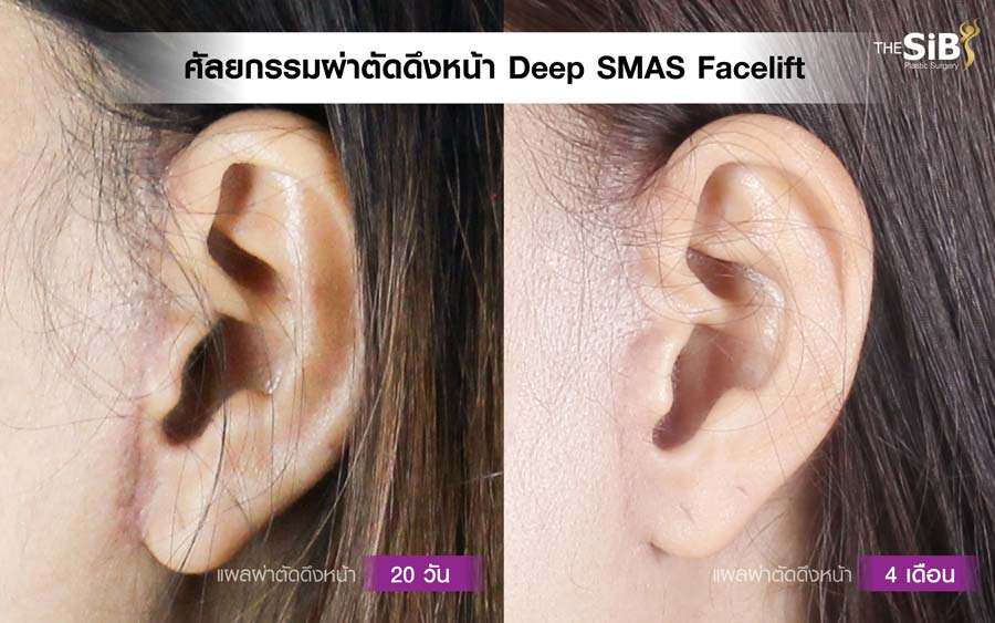 รอยแผลดึงหน้า , facelift scar