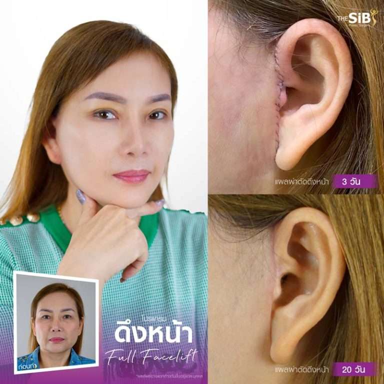 รอยแผลดึงหน้า , facelift scar
