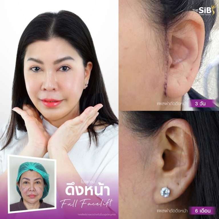 รอยแผลดึงหน้า , facelift scar