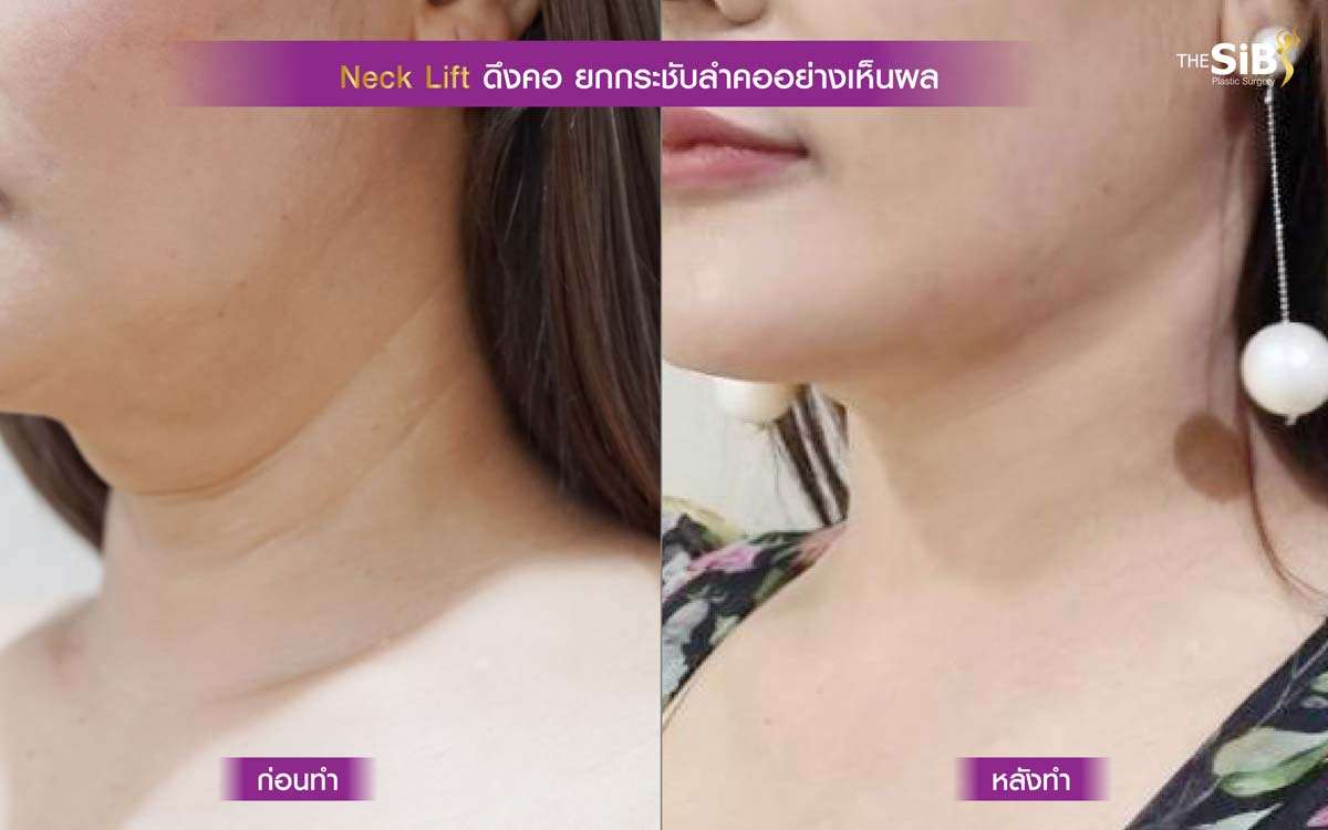 ดึงคอ , necklift