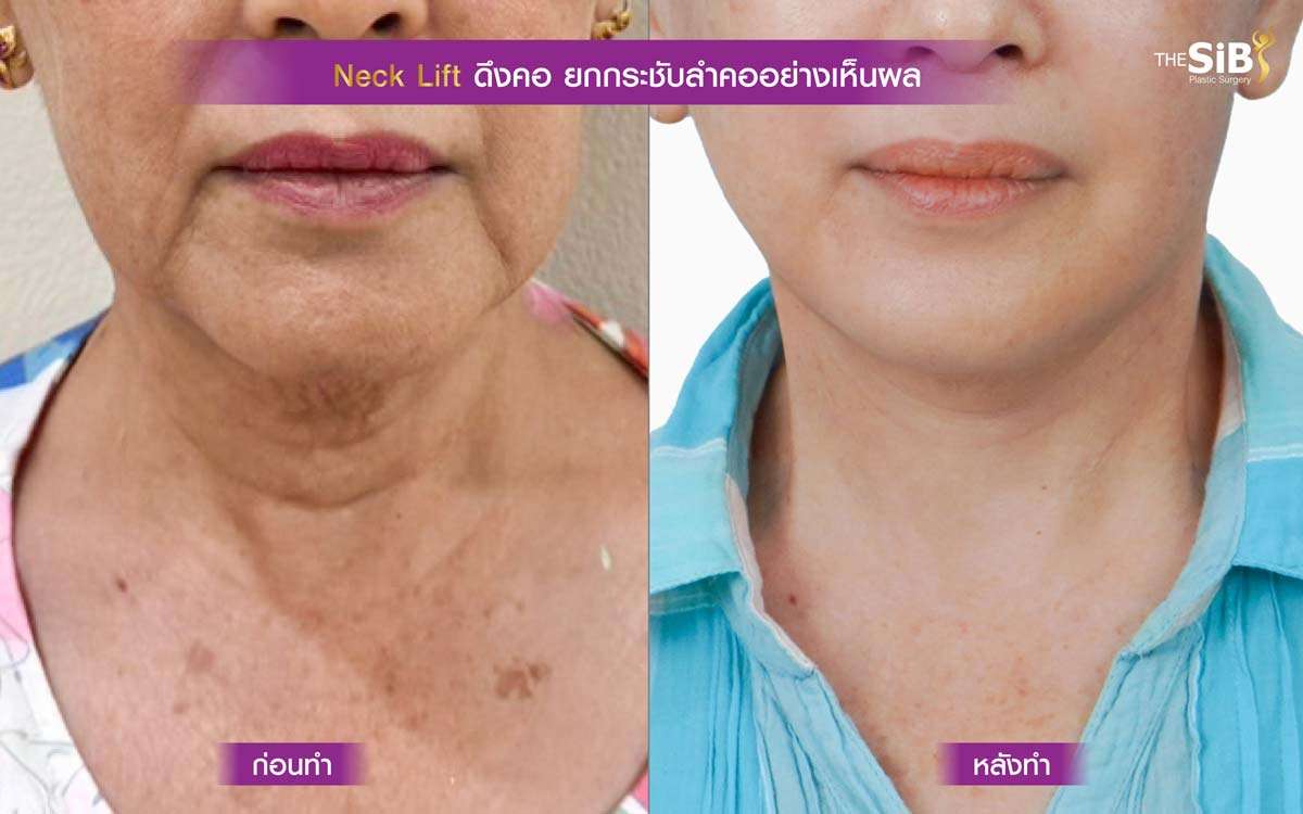 ดึงคอ , necklift