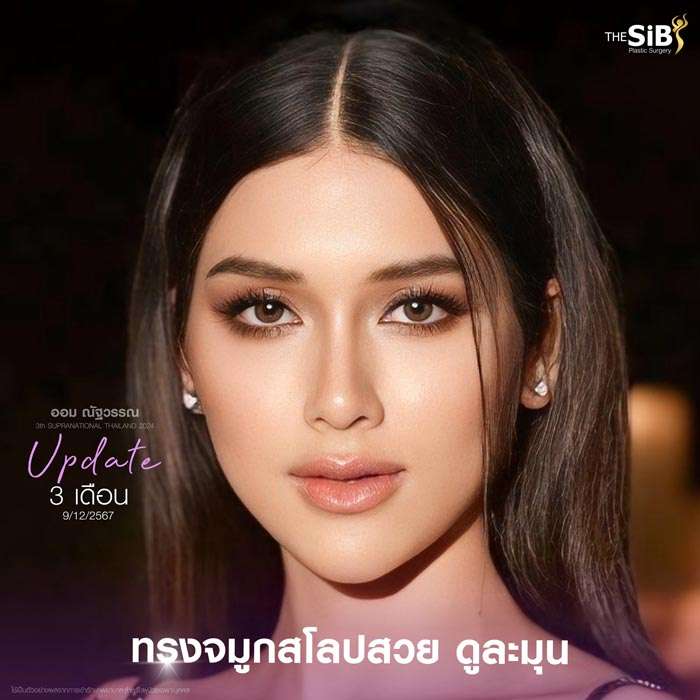 จมูกโอเพ่น , จมูกทรงตุรกี