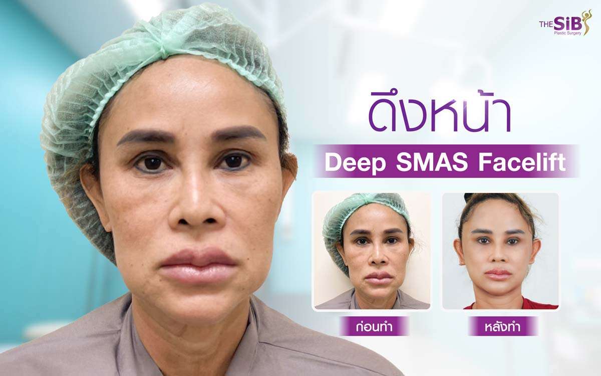 ดึงหน้าชั้นลึก , deep smas facelift