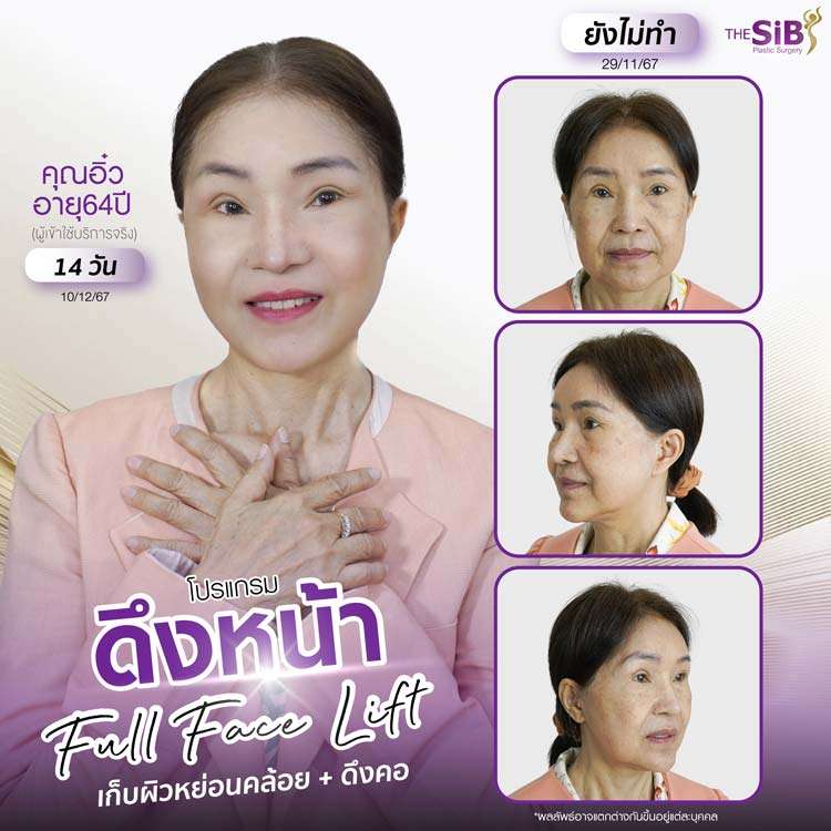 รีวิวดึงหน้า , รีวิวดึงคอ , Full Facelift