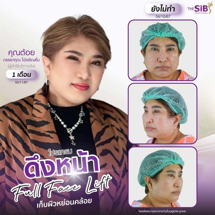 รีวิวดึงหน้า , รีวิวดึงคอ , Full Facelift