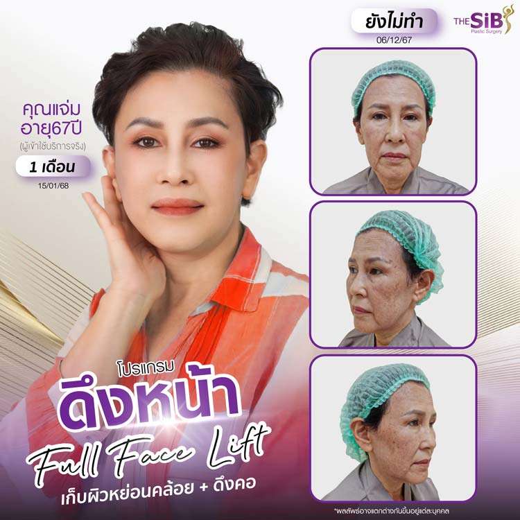 รีวิวดึงหน้า , รีวิวดึงคอ , Full Facelift