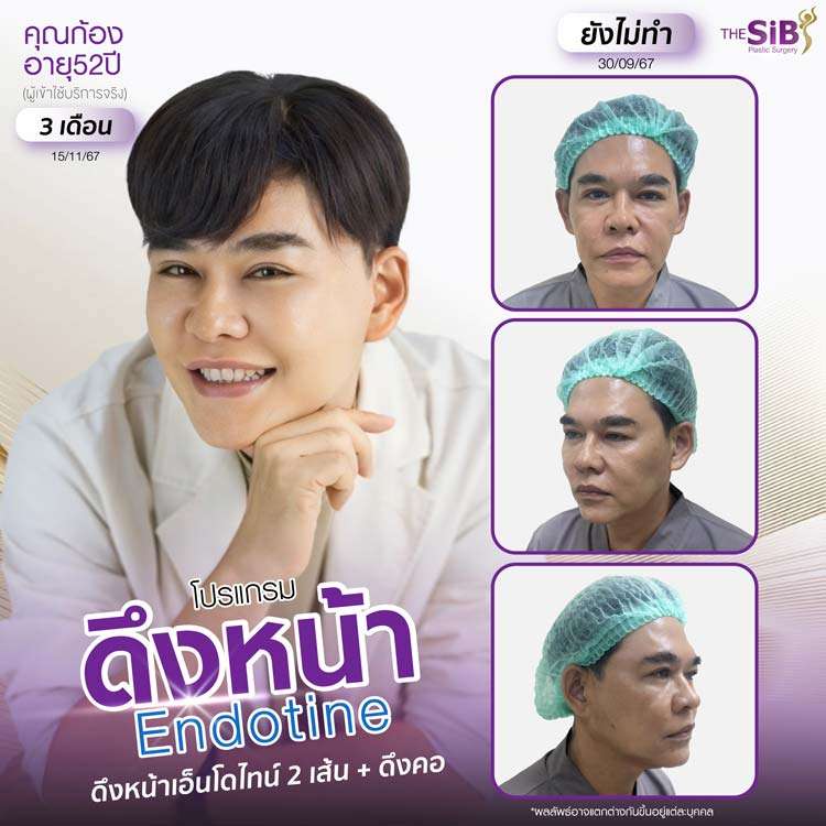 รีวิวดึงหน้า , รีวิว Endotine