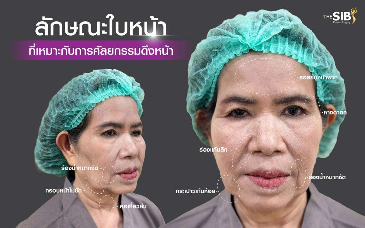 ใบหน้าที่เหมาะกับการดึงหน้า