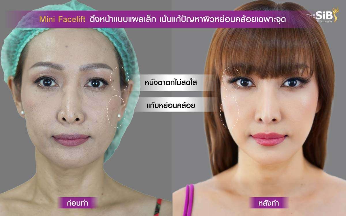 ดึงหน้า , Mini Facelift , Deep SMAS