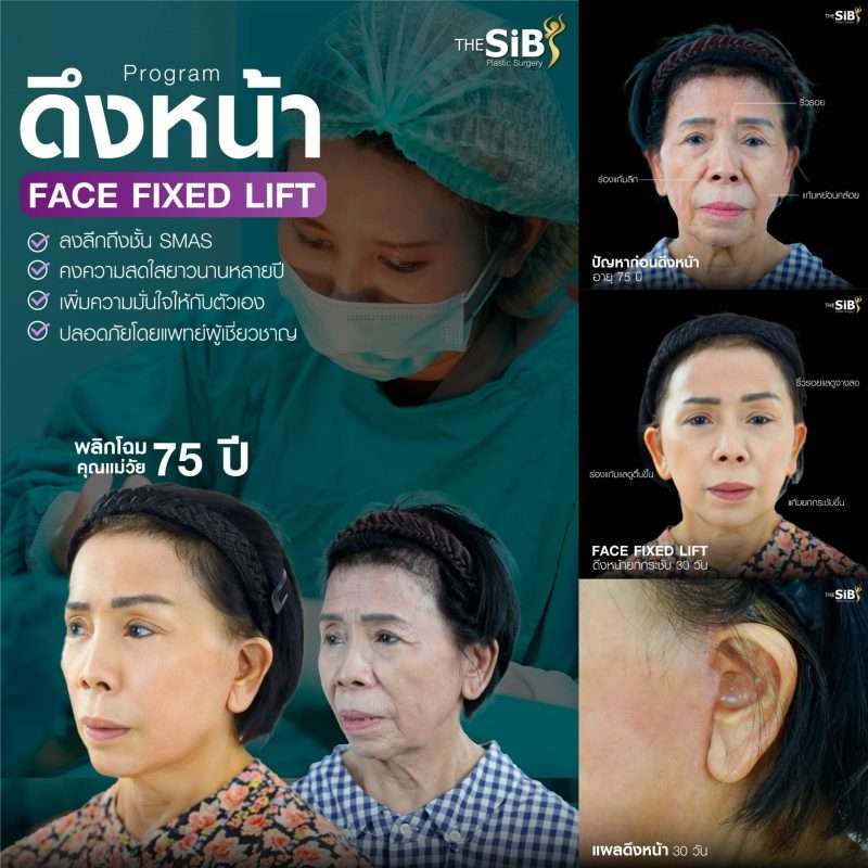 ดึงหน้าอยู่ได้กี่ปี