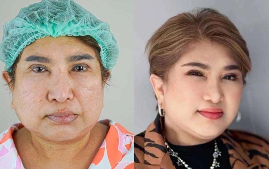 แม่ต้อย , ดึงหน้า