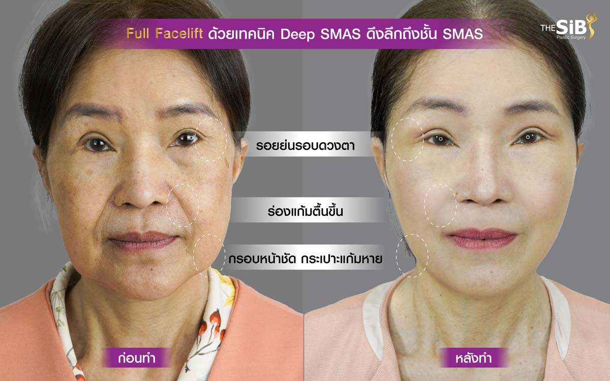ดึงหน้า , Full Facelift , Deep SMAS