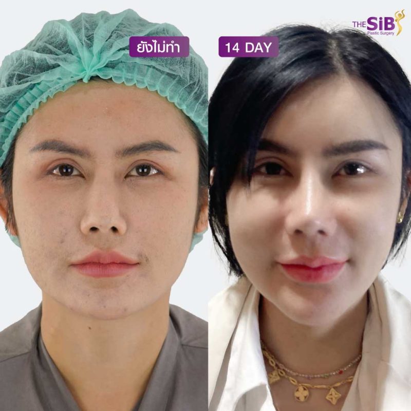 เสริมจมูกด้วยกระดูกอ่อนซี่โครง เปลี่ยนสาวหน้าแข็งให้เป็นสาวหน้าหวานในพริบตา