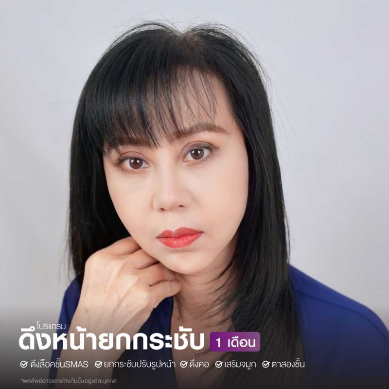 ยกเครื่องใหม่ทั้งหน้าด้วยการศัลยกรรม ดึงหน้ายกกระชับ FULL Face Lift