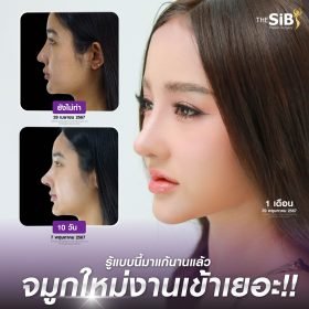 เสริมจมูกผู้หญิง VS เสริมจมูกผู้ชาย