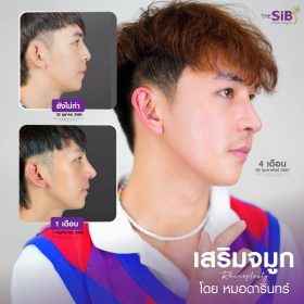 เสริมจมูกผู้หญิง VS เสริมจมูกผู้ชาย