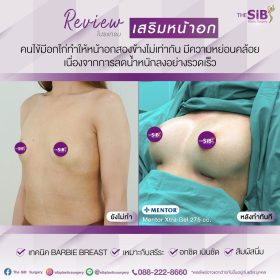 เสริมหน้าอก หลังทำทันที
