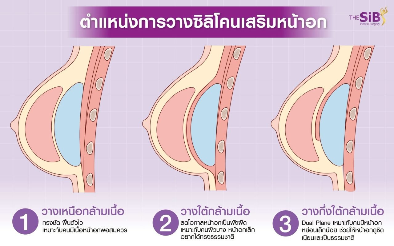 เสริมหน้าอก Barbie Breast ตำแหน่งการวางซิลิโคน
