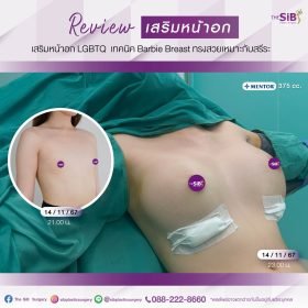 เสริมหน้าอก หลังทำทันที