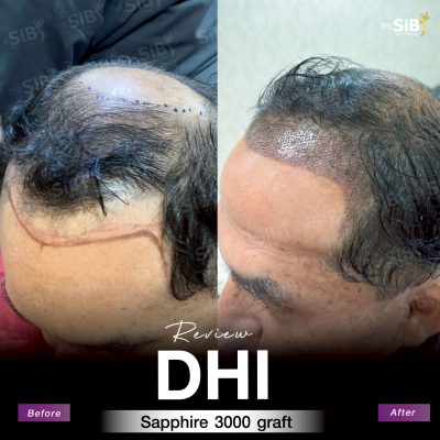 ภาพ B&A ปลูกผม FUE Sapphire