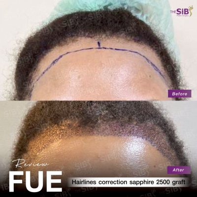 ภาพ B&A ปลูกผม FUE Sapphire ผู้หญิง