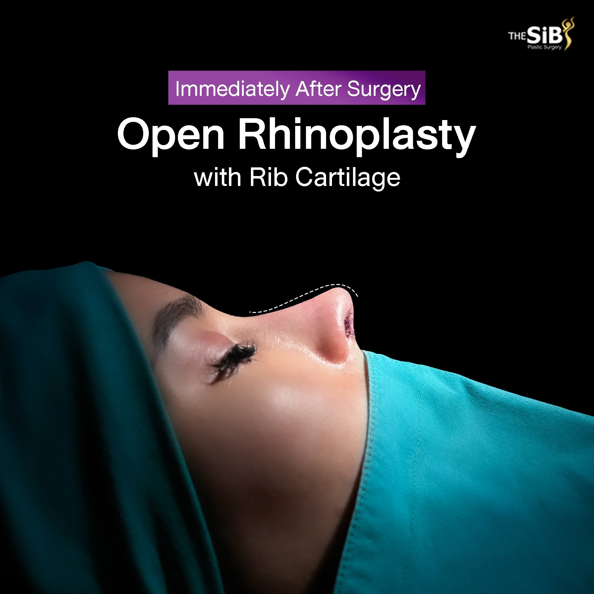 Open Rib Cartilage Rhinoplasty (Open Rib Cartilage Technique) – The SIB ...