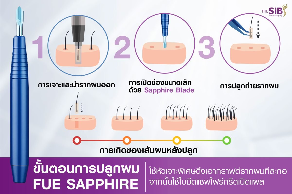 ขั้นตอนการปลูกผม FUE Sapphire