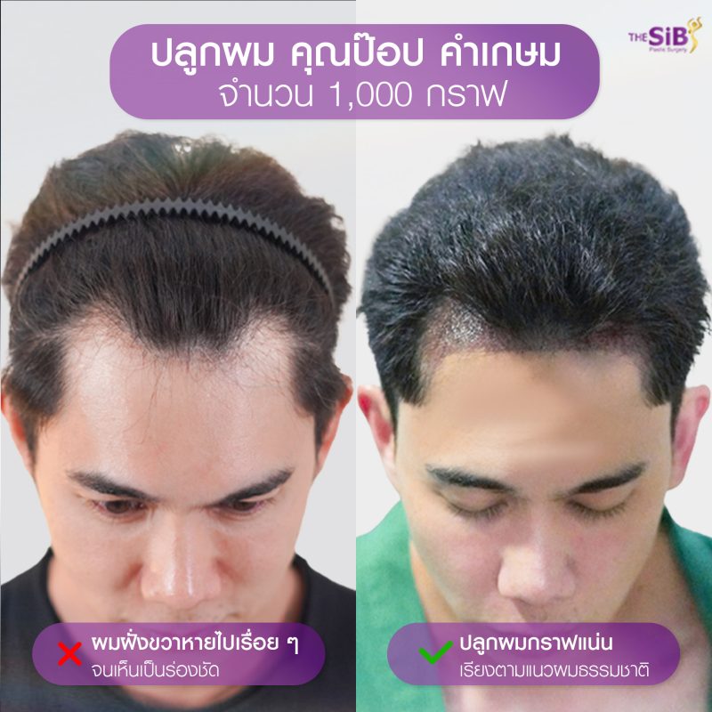 ภาพผลลัพธ์ ก่อนทำหลังทำ ปลูกผมของคุณป๊อป คำเกษม ดารานักแสดง ที่ The SiB Clinic กับคุณหมอดารินทร์ ม่วงไทย