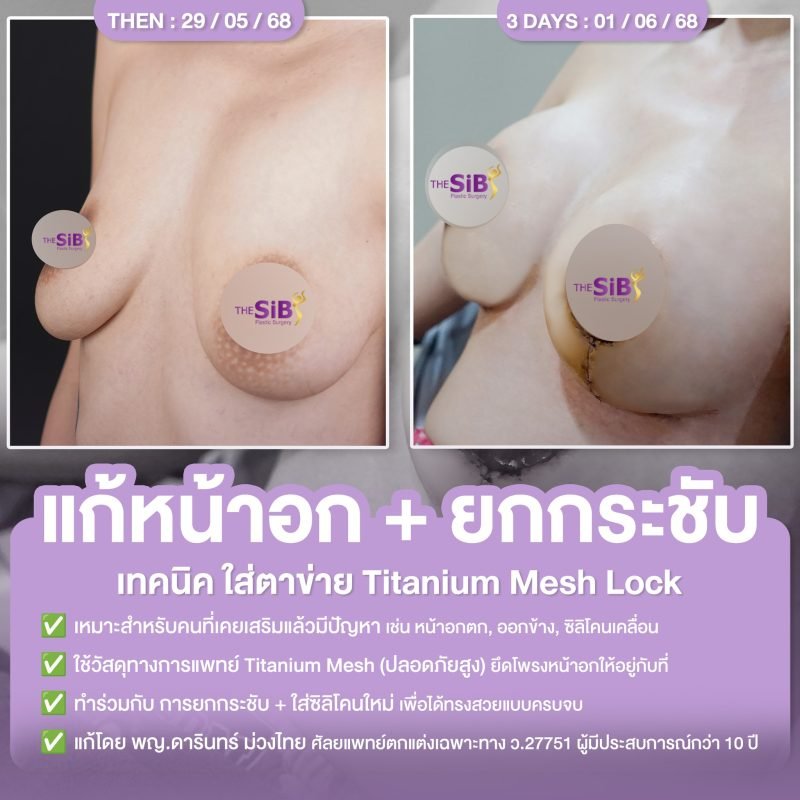 แก้หน้าอกยกกระชับ