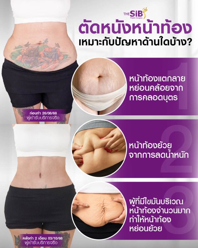 ปัญหาหน้าท้องหย่อนคล้อยหลังคลอดเหมาะกับการตัดหนังหน้าท้อง