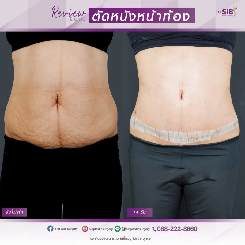 รีวิวก่อนและหลังตัดหนังหน้าท้องที่ The SIB Plastic Surgery