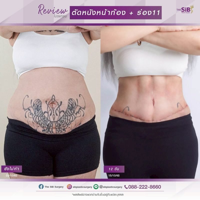 รีวิวก่อนและหลังตัดหนังหน้าท้องที่ The SIB Plastic Surgery