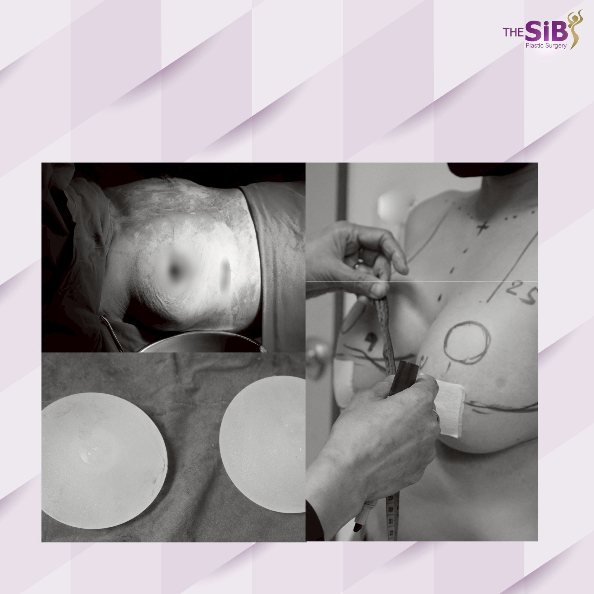 Lollipop Incision Breast Lift – The SIB Plastic Surgery