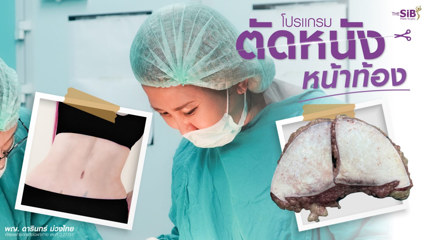 ผลลัพธ์หลังตัดหนังหน้าท้อง พร้อมภาพชิ้นเนื้อไขมันส่วนเกิน