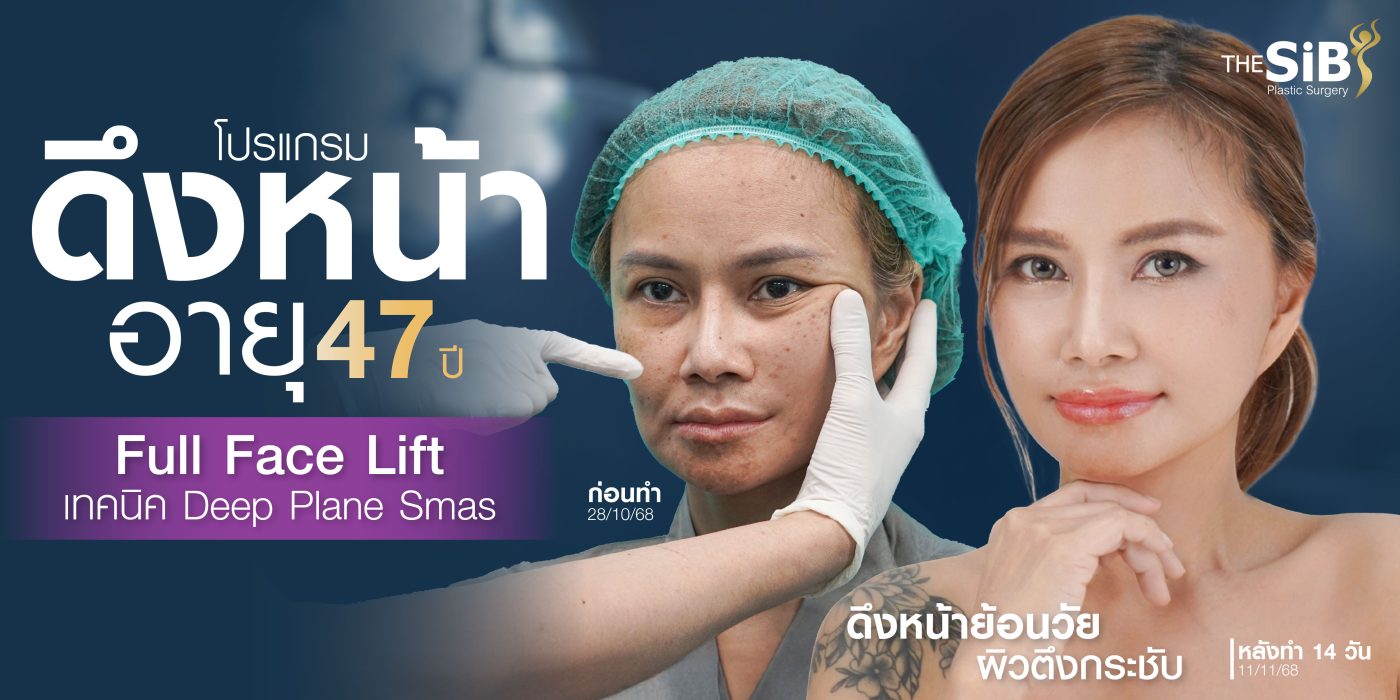 รีวิวดึงหน้า Full Facelift