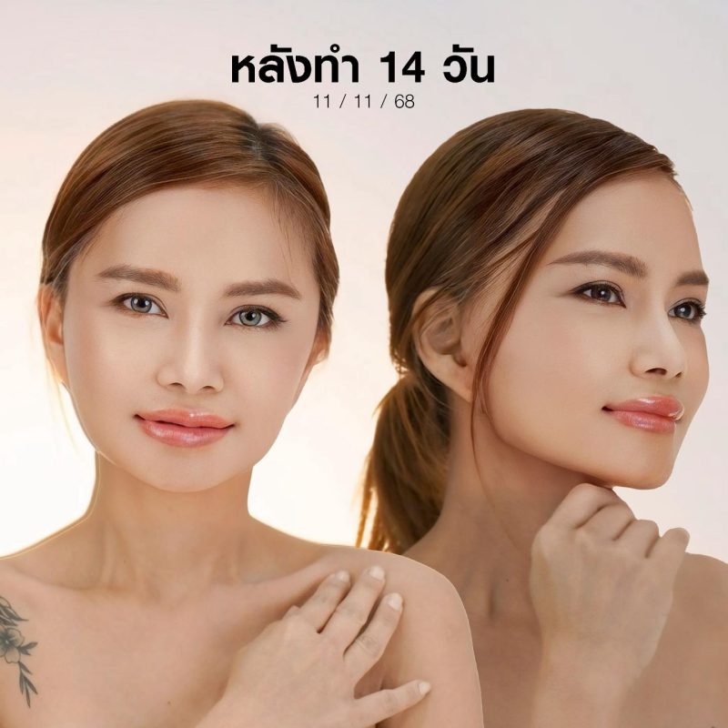 รีวิวดึงหน้า Full Facelift