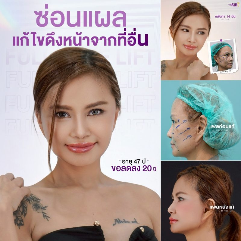 รีวิวดึงหน้า Full Facelift
