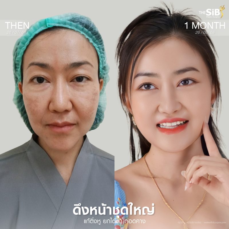 รีวิวเก้ดึงหน้า